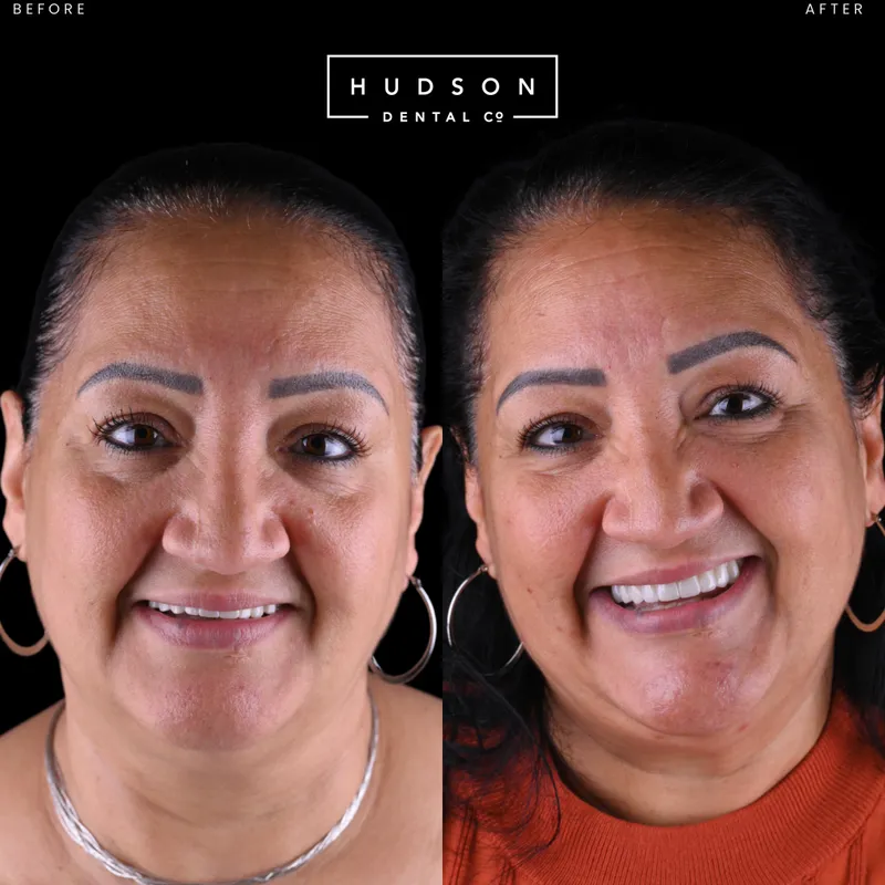 Before and after All-On-X dental implant smile, Hudson Dental Co. patient 1