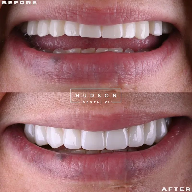 Before and after All-On-X dental implant smile, Hudson Dental Co. patient 2