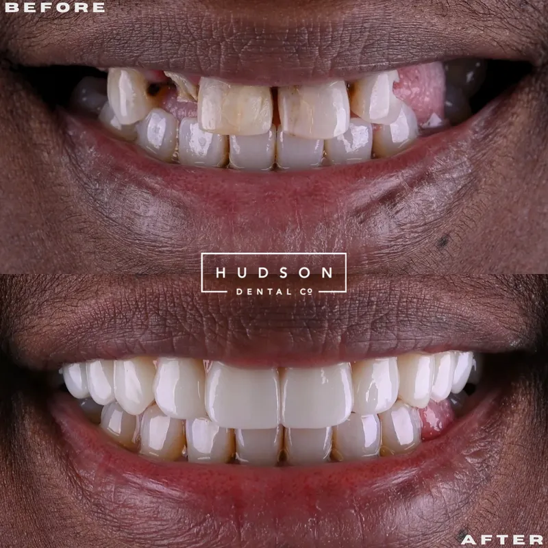 Before and after All-On-X dental implant smile, Hudson Dental Co. patient 3